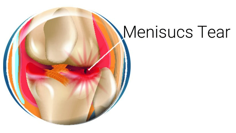 Menisucs Tear in Knee Joint